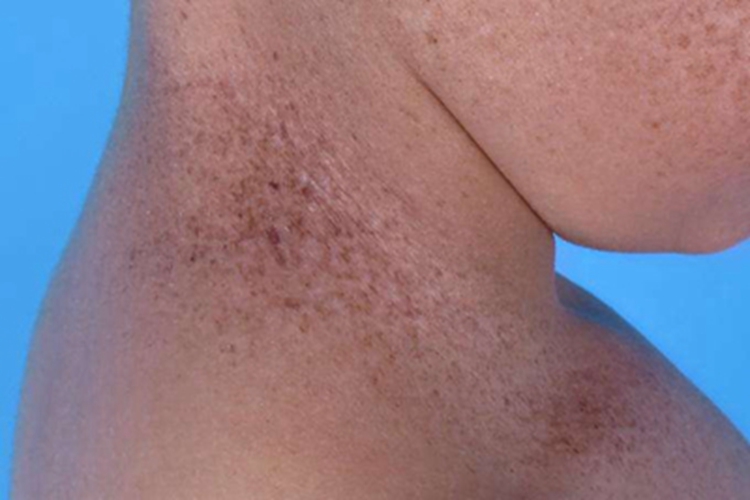 着色性干皮病颈部症状图