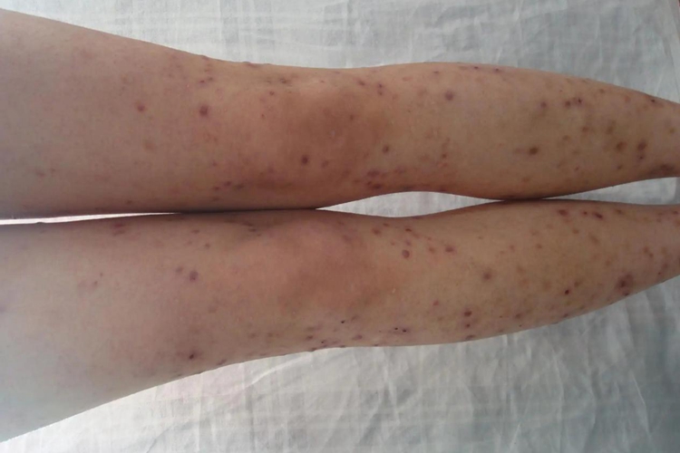 坏死性皮疹图 坏死性皮疹图