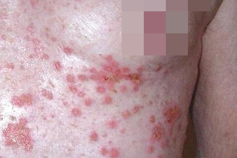 胸部脂溢性皮炎脱屑糜烂图 胸部脂溢性皮炎脱屑糜烂图