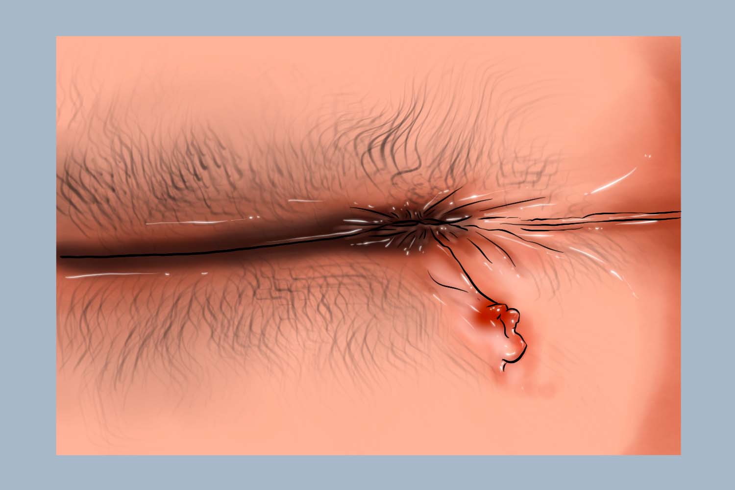 肛瘘溃疡手绘图