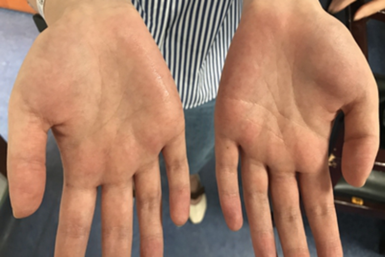 手汗症手部症状图