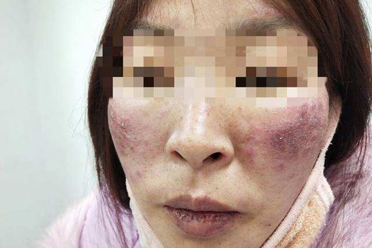 系统性红斑狼疮图