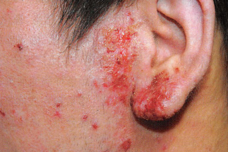 亚急性湿疹糜烂图