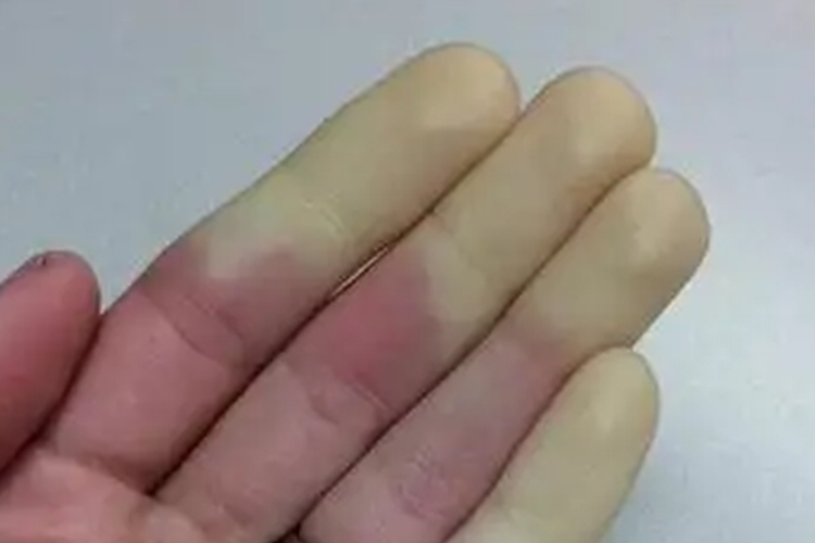 雷诺综合征早期图