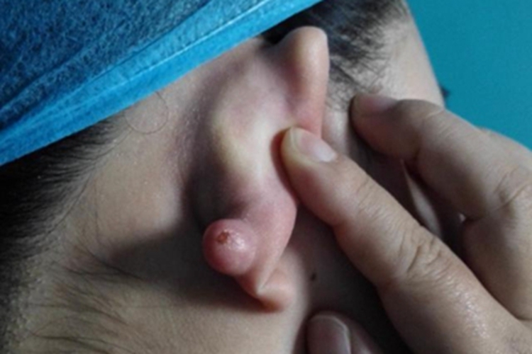 瘢痕疙瘩耳部大疙瘩图 瘢痕疙瘩耳部大疙瘩图