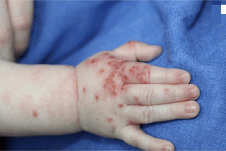 儿童期特应性皮炎手背溃疡图 儿童期特应性皮炎手背溃疡图