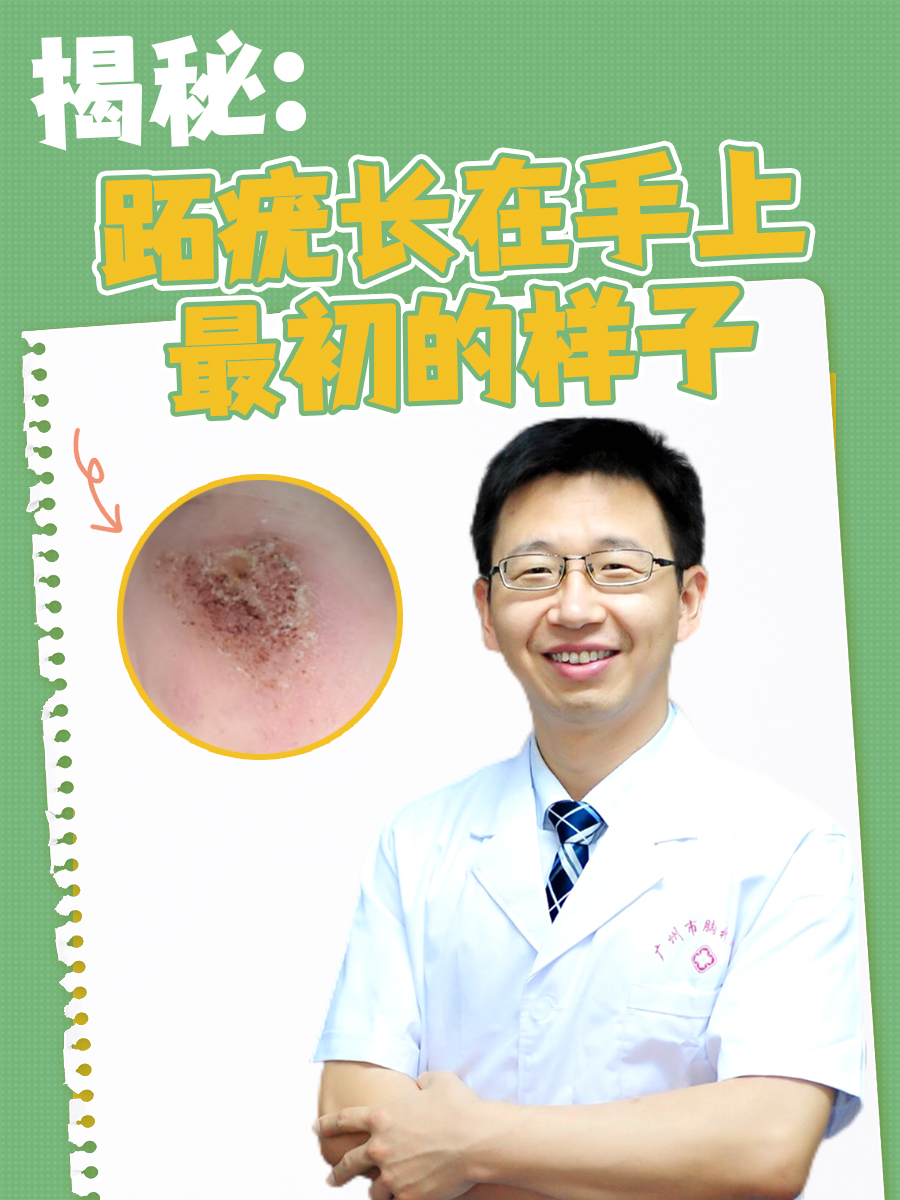 揭秘:跖疣长在手上最初的样子
