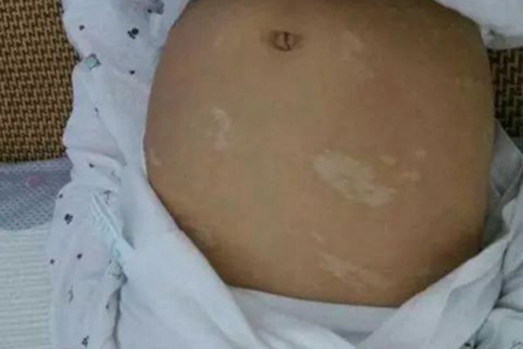 脱色性色素失禁症腹部白斑图