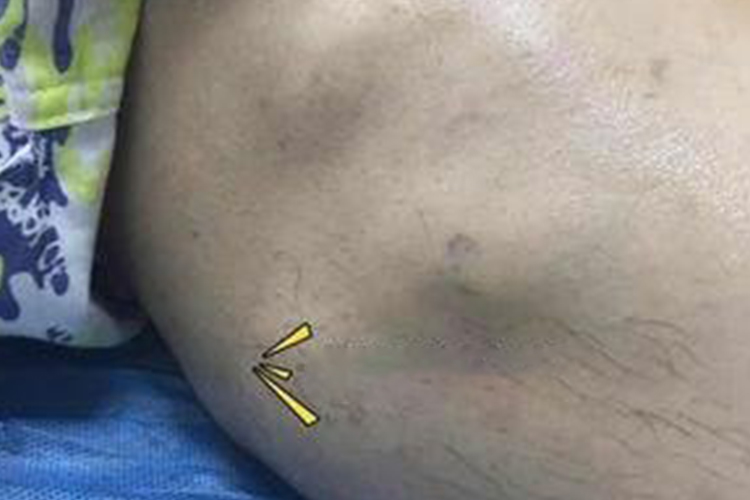 大腿外侧脂肪瘤图