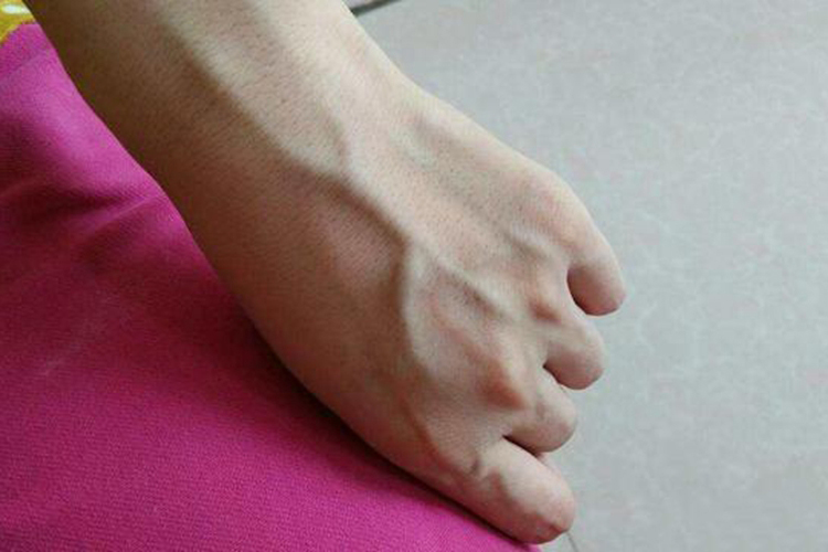 手部血管图 手部血管图