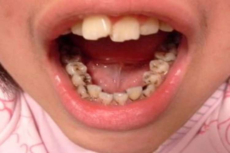 乳牙后牙浅龋图 乳牙后牙浅龋图