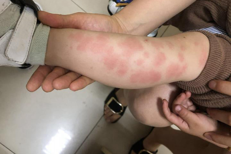 一岁宝宝诱导性荨麻疹图