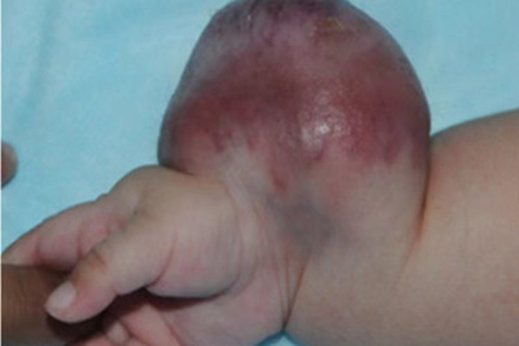 纤维肉瘤手腕大包图