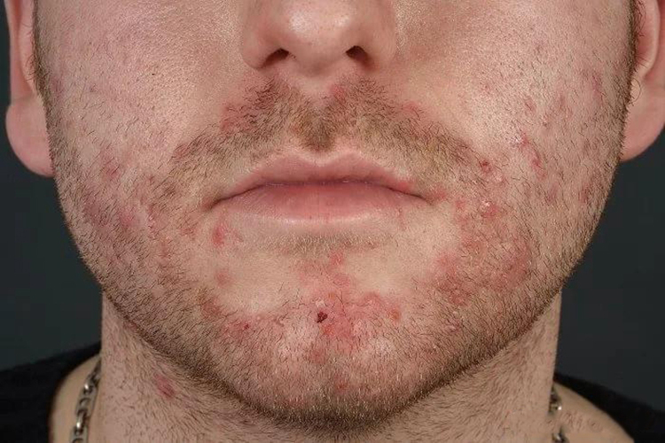 须疮早期丘疹图 须疮早期丘疹图