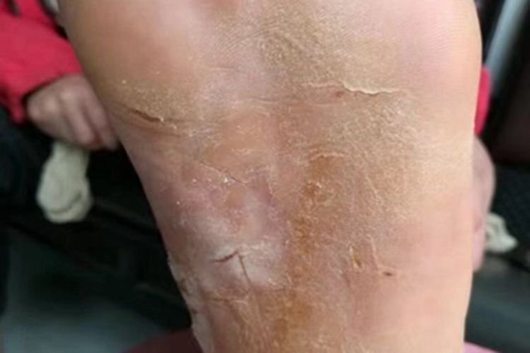 足癣脚底粗糙图