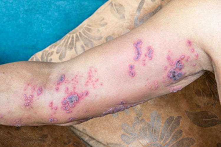 带状疱疹结痂图