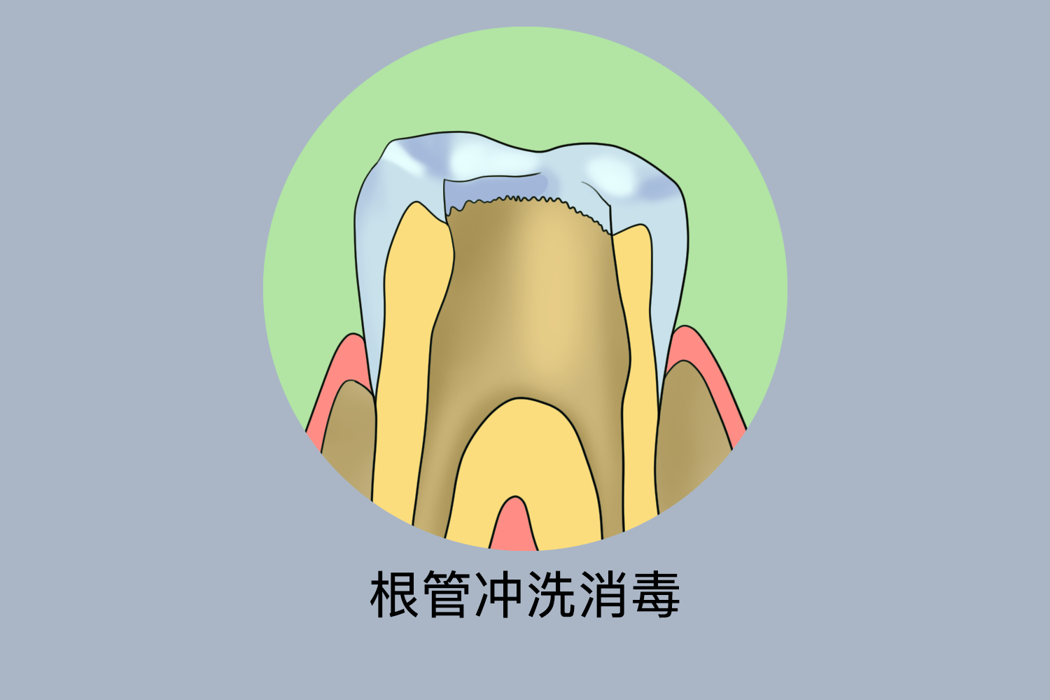 牙齿根管治疗根管消毒图 牙齿根管治疗根管消毒图