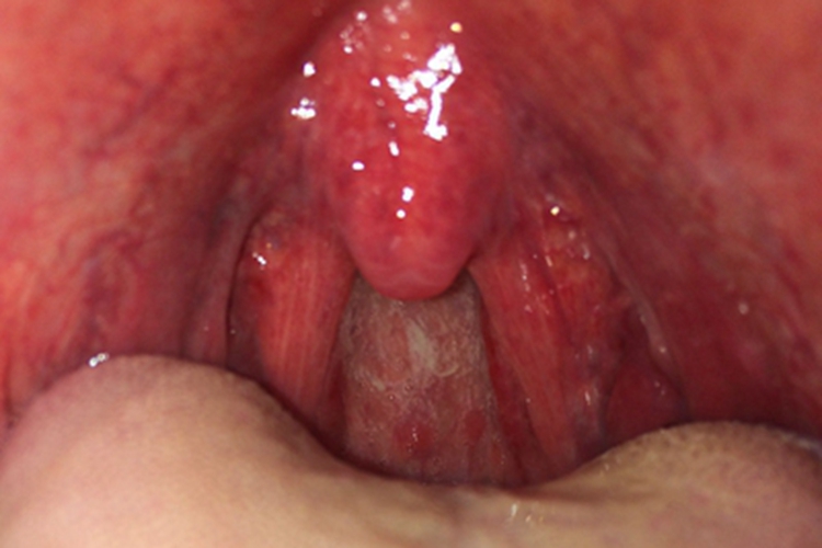 急性化脓性扁桃体炎咽部红肿图