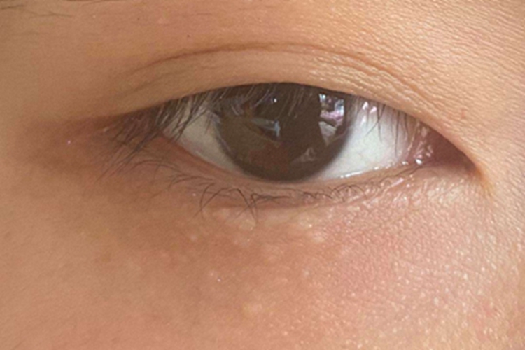 汗管瘤下眼睑肉色凸起图 汗管瘤下眼睑肉色凸起图