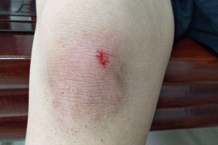 跌伤膝盖红肿有一伤口图