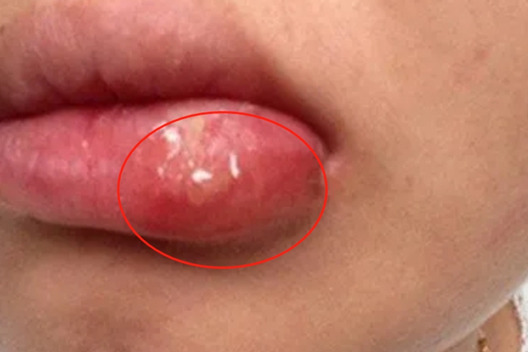 梅毒性唇下疳嘴唇水疱图