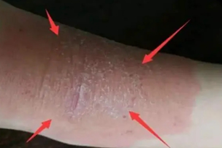 全身性瘙痒症胳膊红斑图 全身性瘙痒症胳膊红斑图