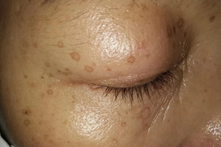 汗孔角化病眼周症状图 汗孔角化病眼周症状图