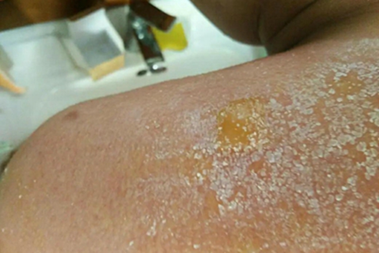 慢性光化性皮炎肩部症状图