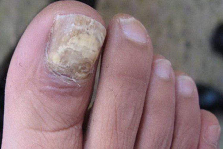 掌跖角皮症脚趾甲增厚图