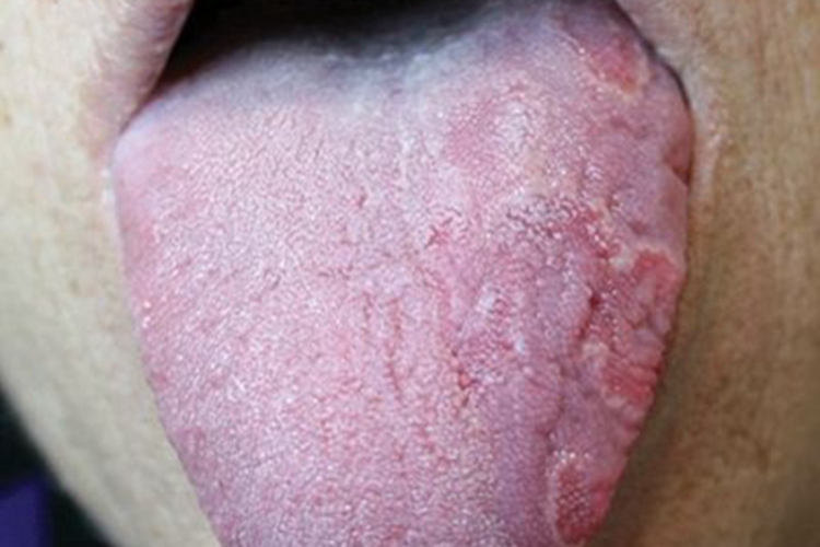 地图舌舌头边缘有红斑图