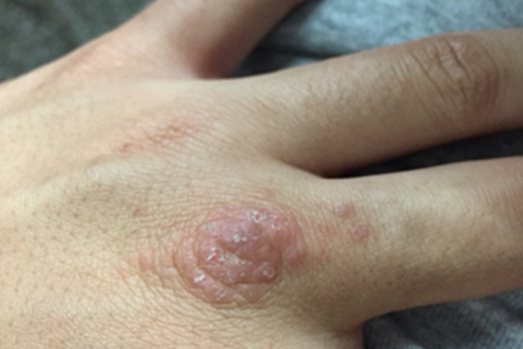 持久隆起性红斑手背红斑脱屑图