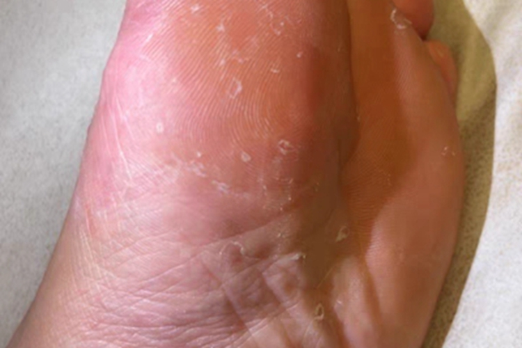 足癣脚底粗糙图