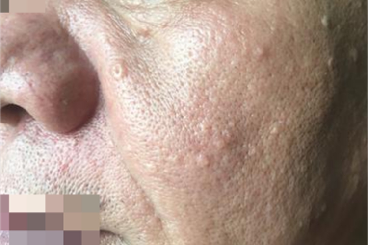 皮脂腺增生面部丘疹图
