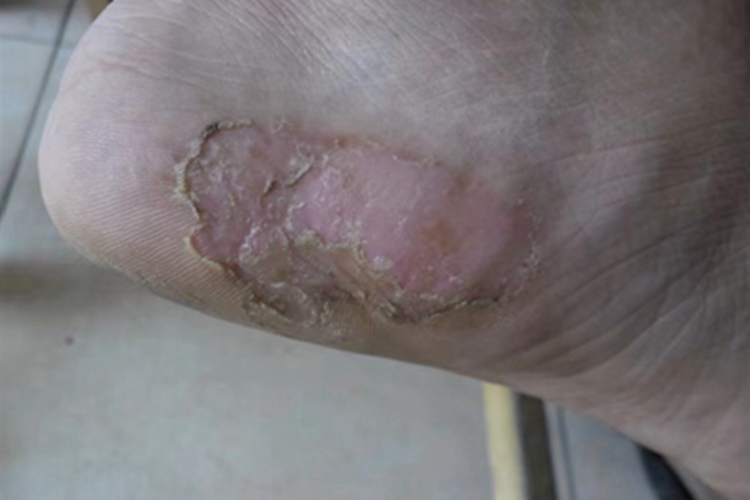 鳞屑角化型足癣脚部粗糙图 鳞屑角化型足癣脚部粗糙图