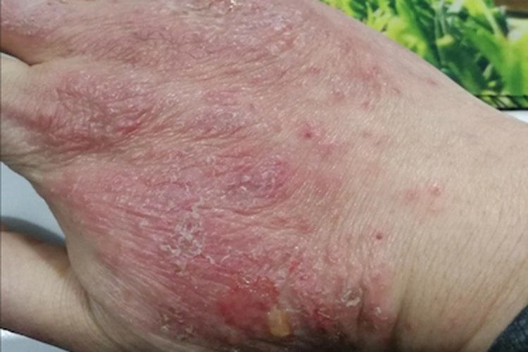 亚急性湿疹手部皮肤粗糙图 亚急性湿疹手部皮肤粗糙图