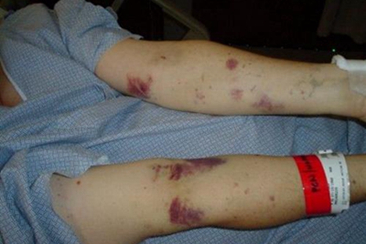 血栓性血小板减少性紫癜紫斑图 血栓性血小板减少性紫癜紫斑图