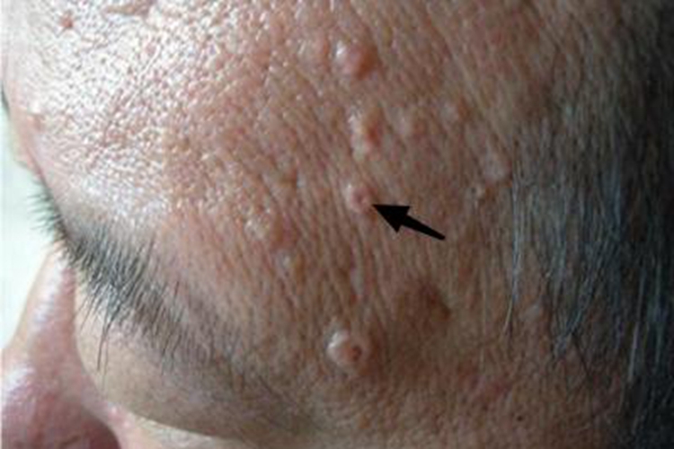 老年性皮脂腺增生小坑图