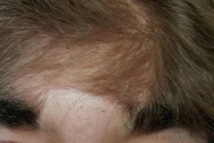 多毛症额头长满长毛图 多毛症额头长满长毛图