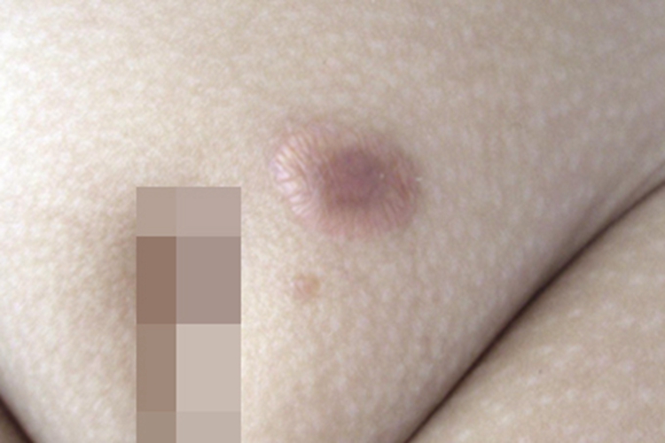 硬化性脂肪肉芽肿会阴部长结节图