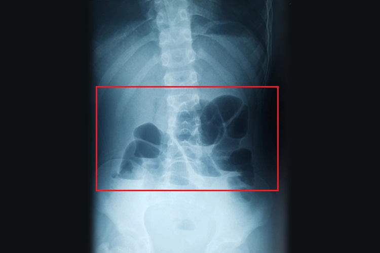 单纯性小肠梗阻DR影像图