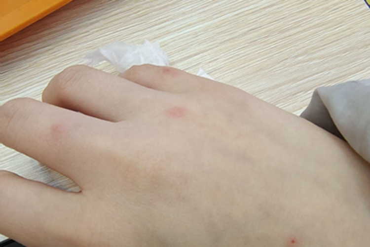 成人痒疹手背有红疹图