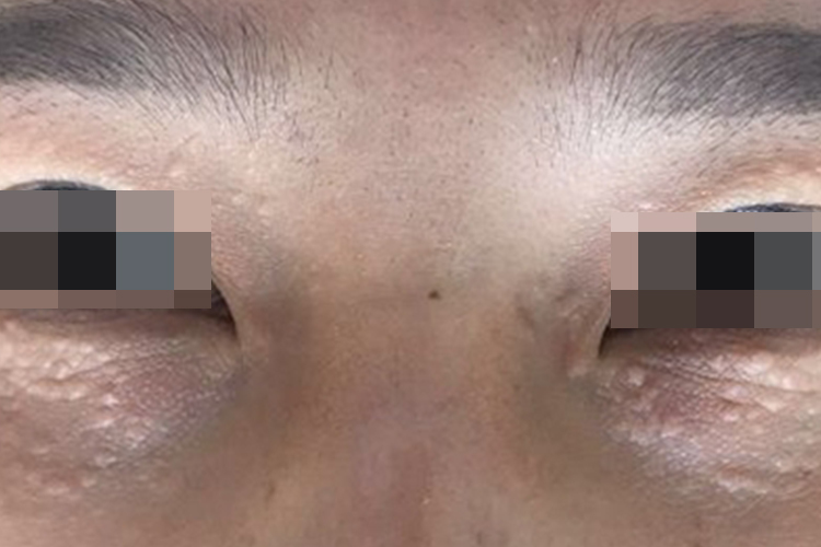 汗腺瘤眼周扁平疙瘩图 汗腺瘤眼周扁平疙瘩图
