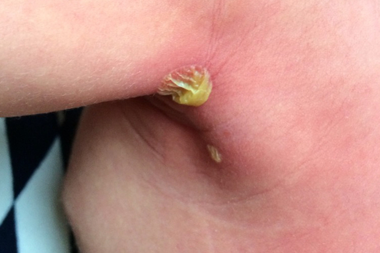 腋下蜂窝织炎图