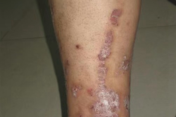 线状苔藓斑图 线状苔藓斑图