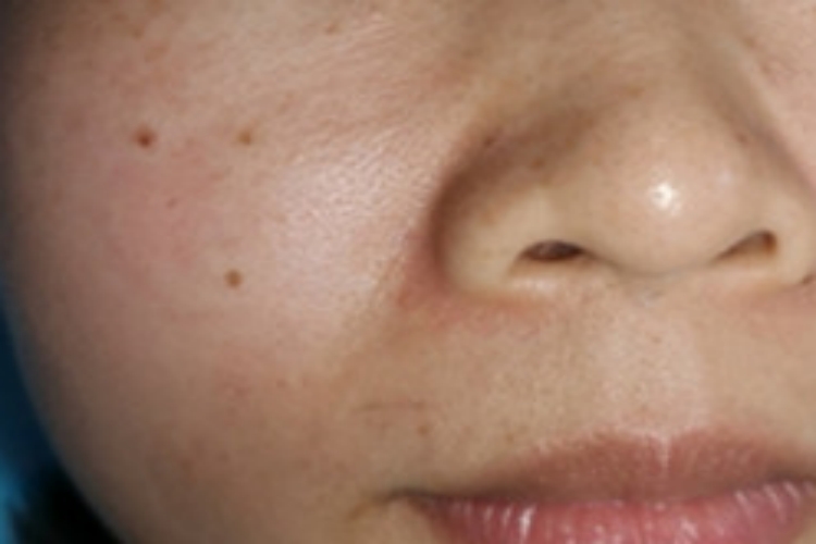 皮内痣脸上有黑斑图