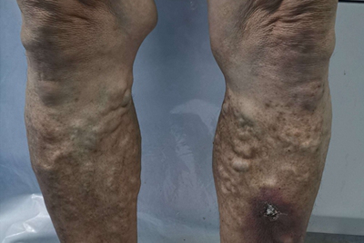大隐静脉曲张小腿皮肤粗糙图