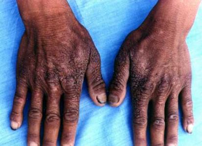 迟发性皮肤卟啉病手背发黑粗糙图.jpeg