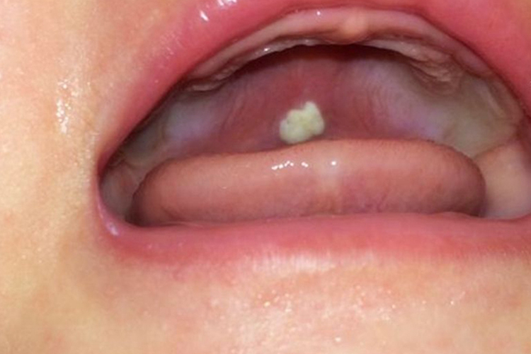 上颚小白点鹅口疮图 上颚小白点鹅口疮图