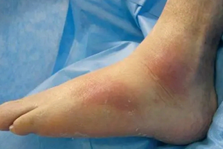 组织细胞吞噬性脂膜炎脚背症状图 组织细胞吞噬性脂膜炎脚背症状图