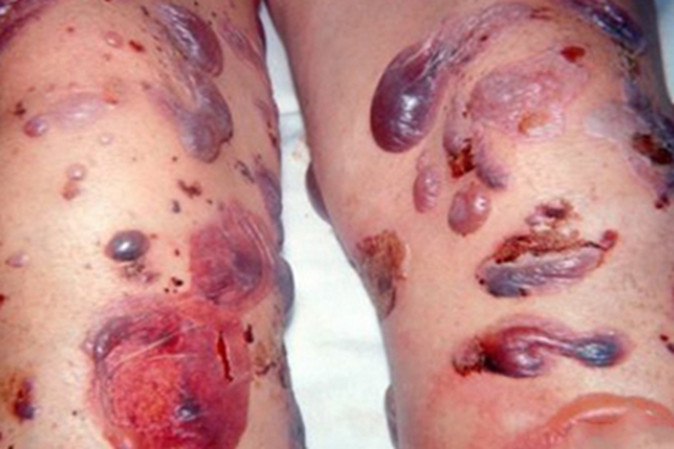 天疱疮腿部大水疱图